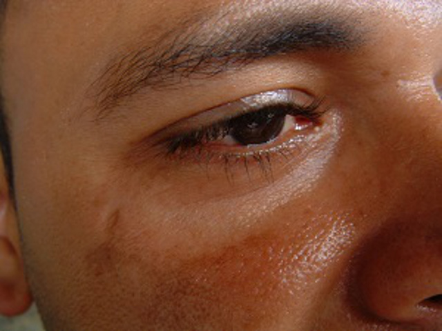 Pigmentflecken – gefährlich oder harmlos?